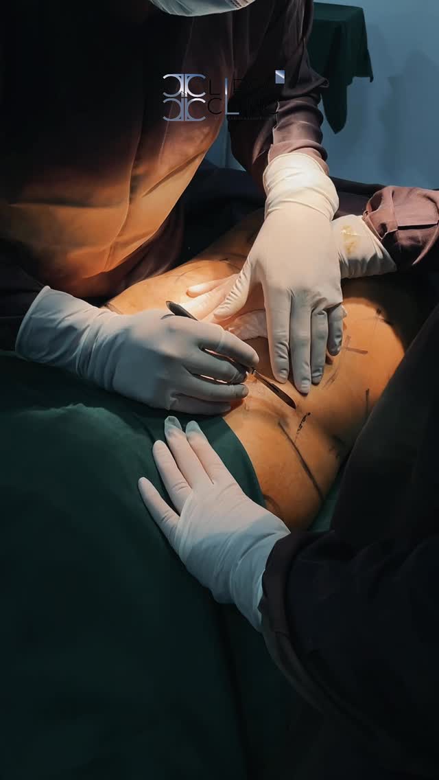 QUÉ ES LA LIPOESCULTURA